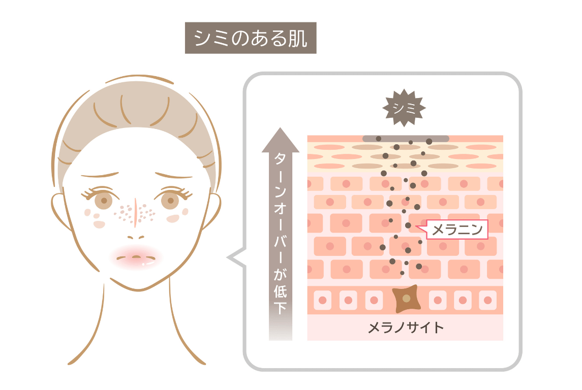 鼻シミの原因：詳細解説